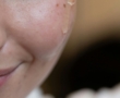 Dermatitis seborreica, guía completa para cuidar tu cuero cabelludo