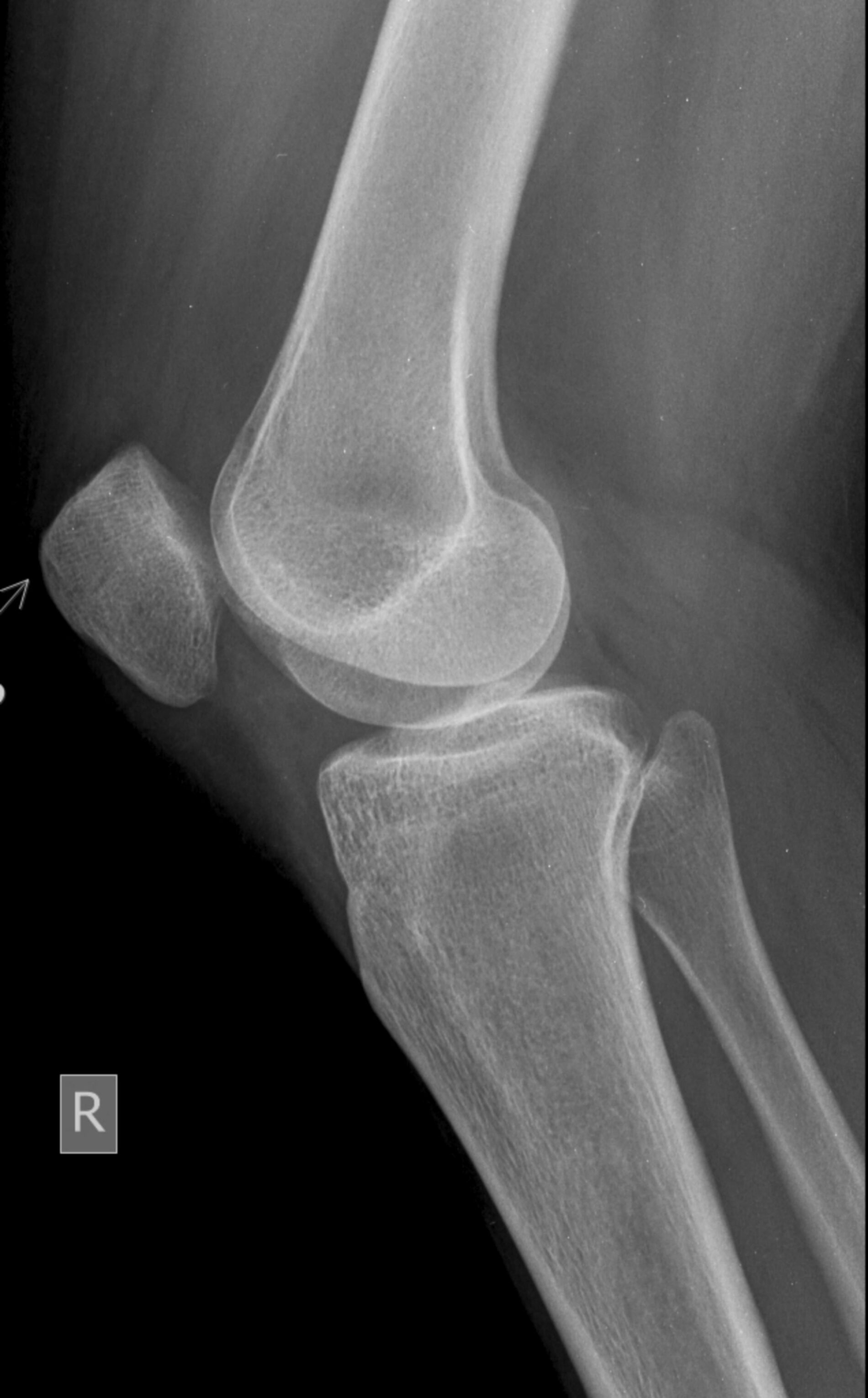 Osteoporosis