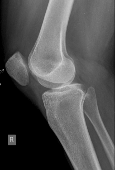 Osteoporosis en mujeres +40: cómo fortalecer tus huesos